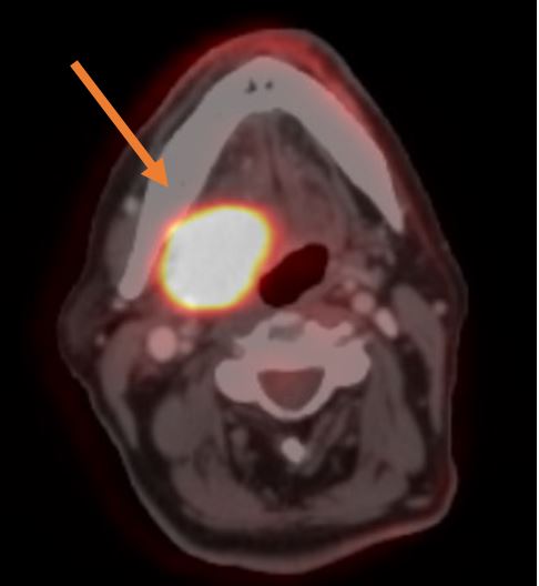 Cáncer en la garganta por papilomavirus VPH