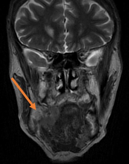 Cáncer en la garganta por papilomavirus VPH