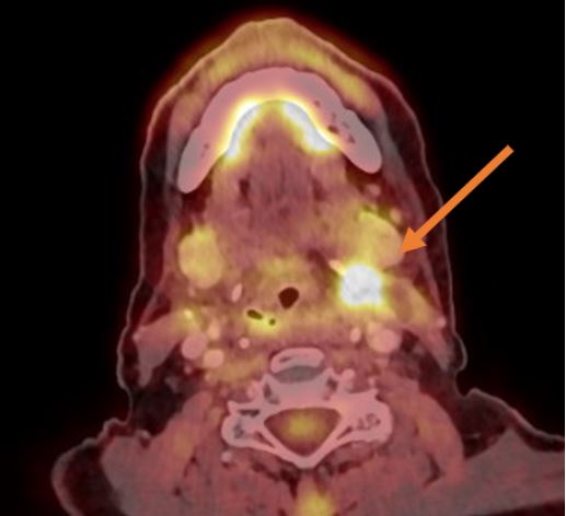 Cáncer en la garganta por papilomavirus VPH
