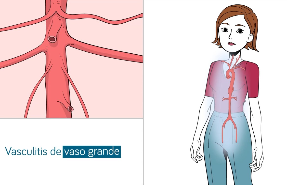 Arteritis de Takayasu: Una vasculitis de causa desconocida