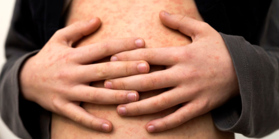 OMS advierte que hay un «alto riesgo» por brotes de sarampión en 2024