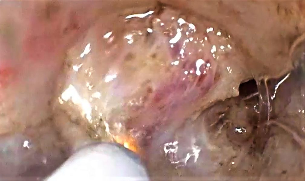 Edoscopia predictiva del cáncer en el tubo digestivo