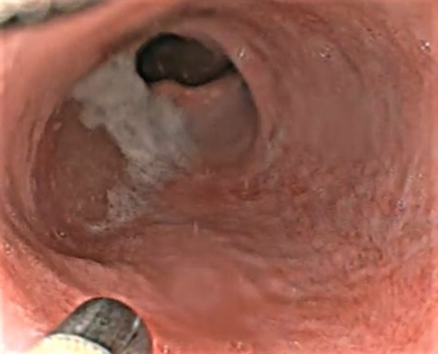 Edoscopia predictiva del cáncer en el tubo digestivo
