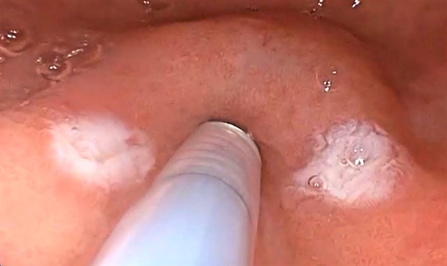 Edoscopia predictiva del cáncer en el tubo digestivo