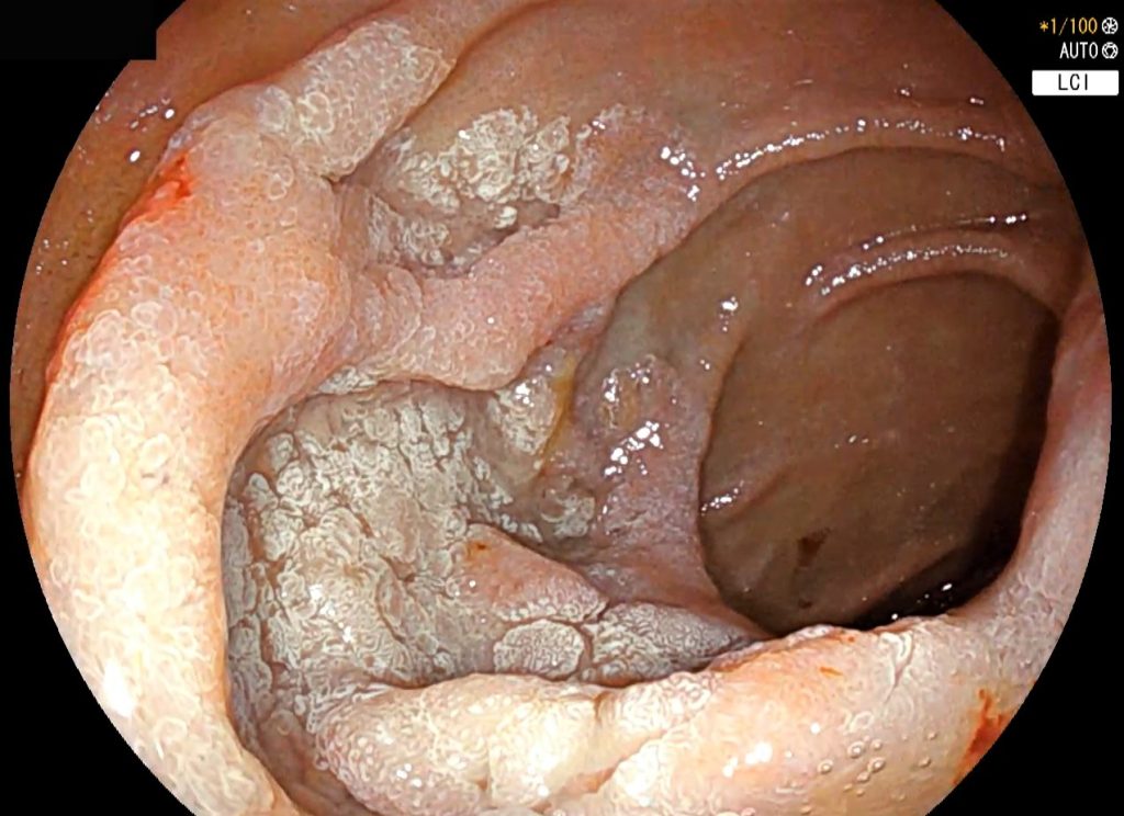 Edoscopia predictiva del cáncer en el tubo digestivo