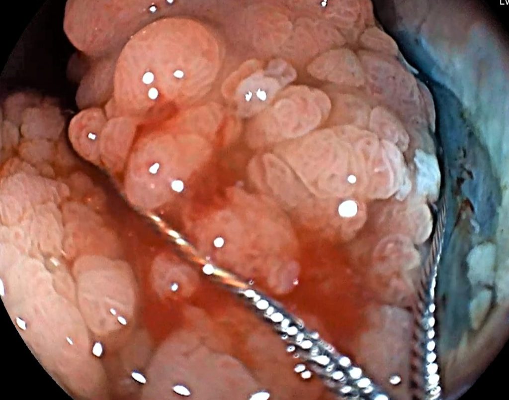 Edoscopia predictiva del cáncer en el tubo digestivo