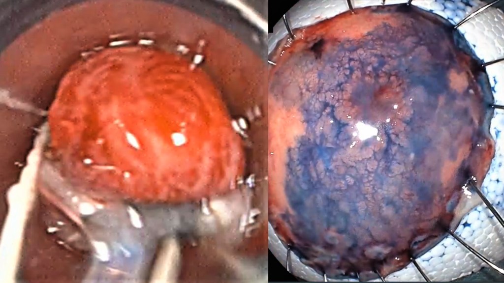 Edoscopia predictiva del cáncer en el tubo digestivo