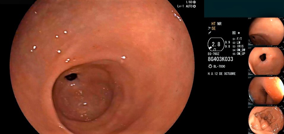 Viaje endoscópico por el tubo digestivo: estómago y duodeno.