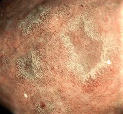 Viaje endoscópico por el tubo digestivo: estómago y duodeno.