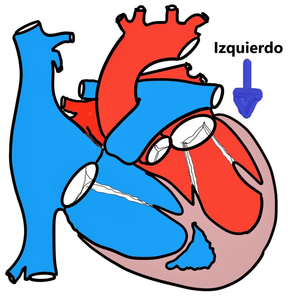 Cardiopatías congénitas.