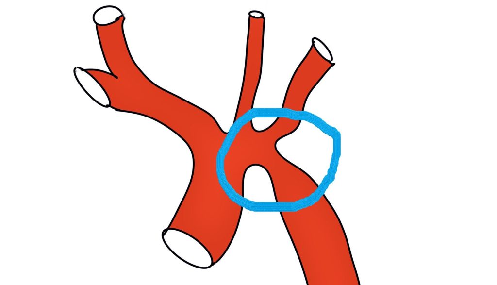 Cardiopatías congénitas.