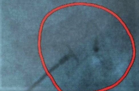 cardiopatías congénitas