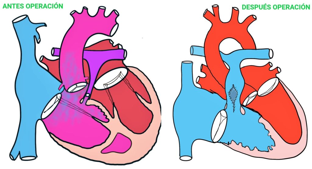Cardiopatías congénitas.